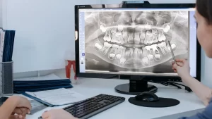 A close-up of a healthy set of wisdom teeth that have been kept intact in the mouth, showing proper alignment and no signs of decay or crowding. The image illustrates that can you keep your wisdom teeth if they are not causing any dental issues.